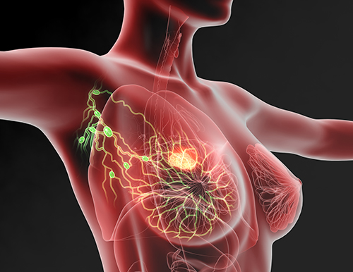 Breast-Cancer-sentinel-lymphnode